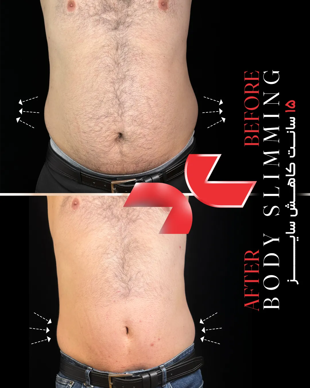 پیش‌نمایش لاغری موضعی